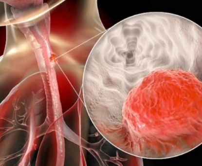 Các dấu hiệu nhận biết sớm ung thư thực quản